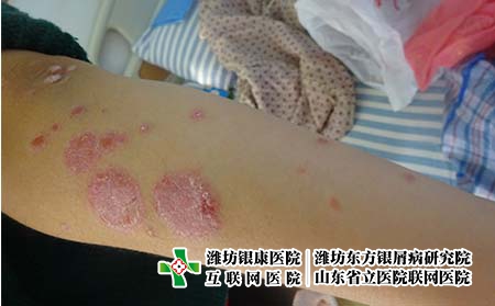 [济南银屑病怎么走]银屑病患者如何与医生沟通有效