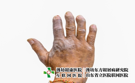 摄图网_324104120_隔离在白种背景 皮肤病和皮肤衰竭的农民手中的丝虫病近距离特写 而Psoralpic手指畸形（企业商用）
