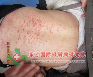 银屑病