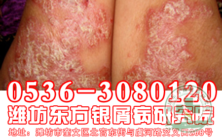 牛皮癣患者冬季如何为皮肤补水
