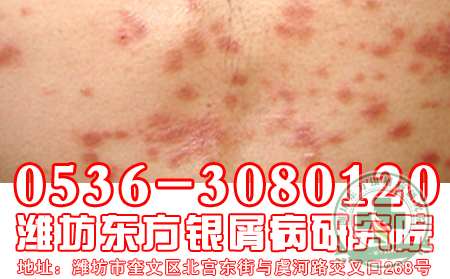 牛皮癣患者日常养护需要注意什么