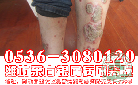 脸部牛皮癣的诱发因素有哪些呢?