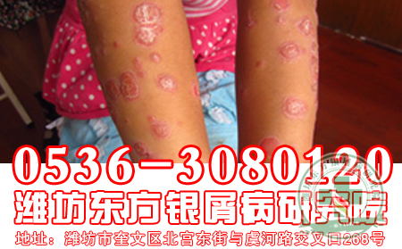 牛皮癣患者如何激发自我调节和修复能力呢?