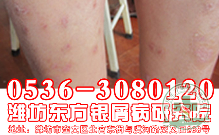 季节的变化能够影响牛皮癣吗?