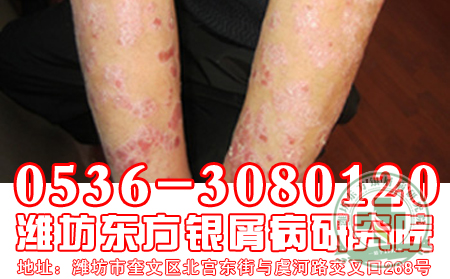 2013世界银屑病日，关爱银屑病患者健康