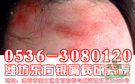 脓疱型牛皮癣治疗要注意什么呢?