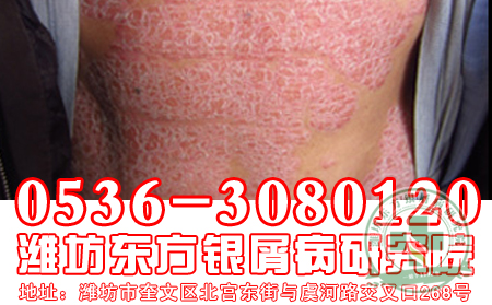 秋冬季节，牛皮癣患者如何护理呢?