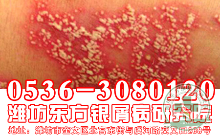 芦荟可以治疗牛皮癣，是真的吗?