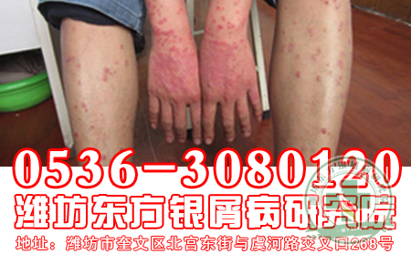 牛皮癣患者如何缓解手脚冰凉的现象?