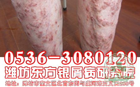 牛皮癣患者如何自我护理呢?