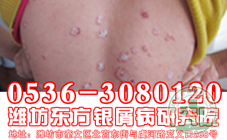 悲观的心理容易诱发牛皮癣