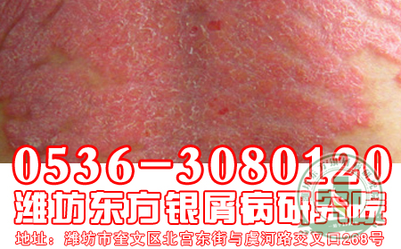 牛皮癣患者可以吃鲜枣吗?