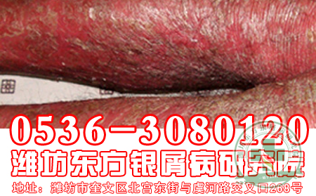 秋季牛皮癣患者如何防嘴唇干裂?