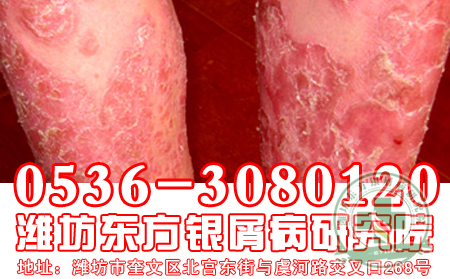 什么样的女性更容易患有牛皮癣呢?
