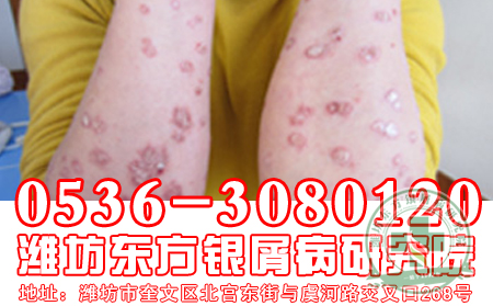 牛皮癣患者如何进行心理治疗呢?