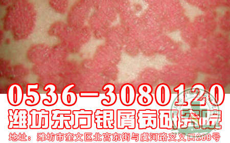 牛皮癣患者生活小常识