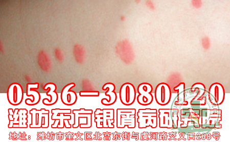 孕妇牛皮癣患者要注意什么呢?