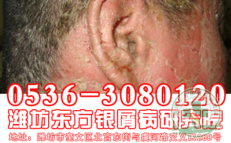 头部银屑病该如何洗发