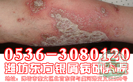 济南牛皮癣医院——牛皮癣患者饮食有“讲究”，病才可以得快
