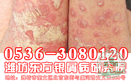 银屑病准妈妈们应该如何做好孕期护理