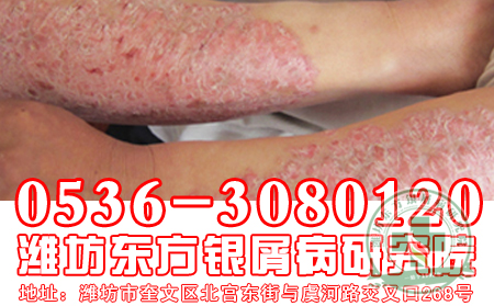 谁该为银屑病久治不愈埋单？【全国十佳医院】