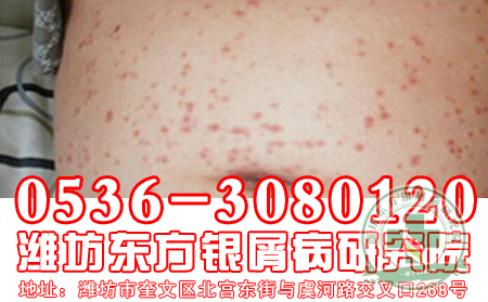 银屑病日常护理做到哪些对患者病情有利