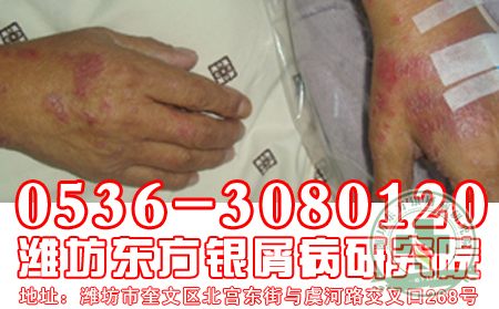 银屑病预防：从一点一滴小事做起【共同关注】