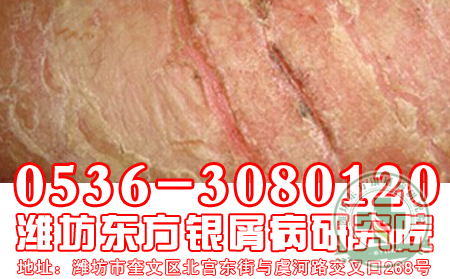银屑病患者日常饮食要避免触及禁忌