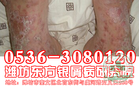 寻常型牛皮癣会因为哪些因素而出现