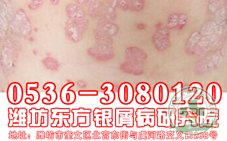 济南牛皮癣医院医生呼吁：呵护双脚，远离脚部银屑病