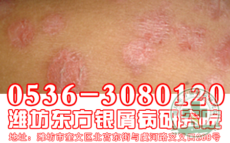 深入探讨：医生探究银屑病病因