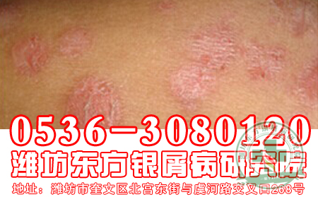中药治疗银屑病的优势在哪