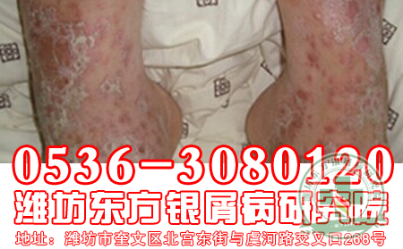 银屑病的日常护理有必要去做吗