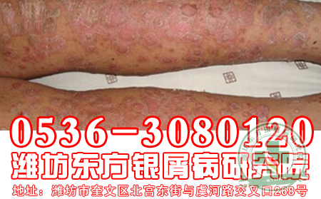 患有牛皮癣患者初期有哪些症状
