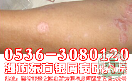 护理牛皮癣，我们要从哪里做起
