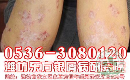 银屑病患者用醋泡脚有什么简单方法？