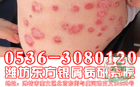 治疗牛皮癣专科医院孩子得牛皮癣有什么明显症状