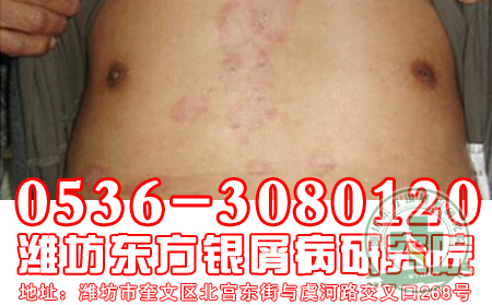 中医治疗牛皮癣优势大揭密