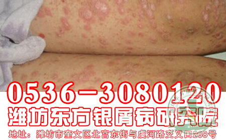得了银屑病莫发慌，妙手仁医找东方