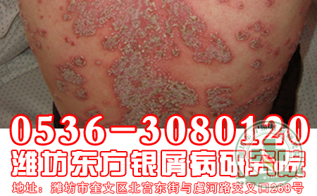 医生解读银屑病和气候的关系