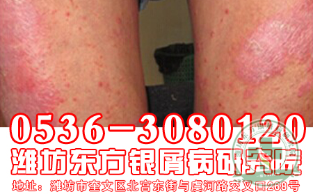 银屑病短期内是否能恢复