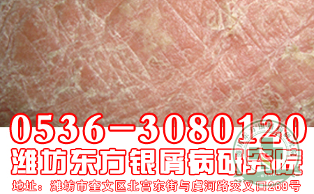 治疗银痟病 可以的手段是什么？【专业=一】