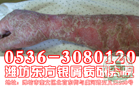 医生和你聊聊头部银屑病饮食护理问题