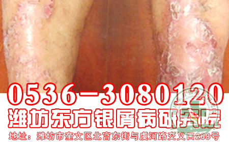 银屑病饮食护理莫着急，“豆豆”帮你解决大问题