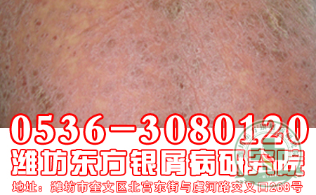山东牛皮癣医院：牛皮癣治疗中 可以的方法是什么？【医院在线】