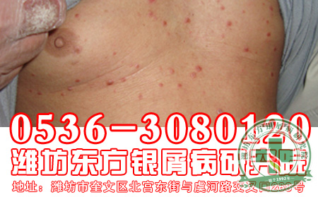 牛皮癣患者洗澡时应注意的问题