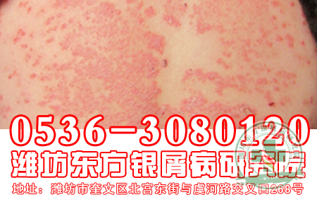 女性银屑病患者烫发须知