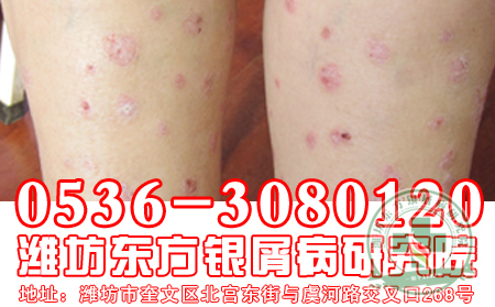 医生答疑银屑病患者性生活是否会加重病情