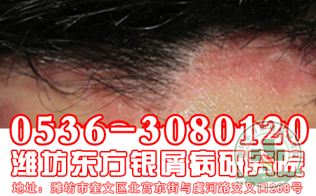 银屑病 可以的治疗方法是什么？【全国十佳医院】