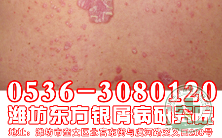 香蕉皮能缓解银屑病病情吗？